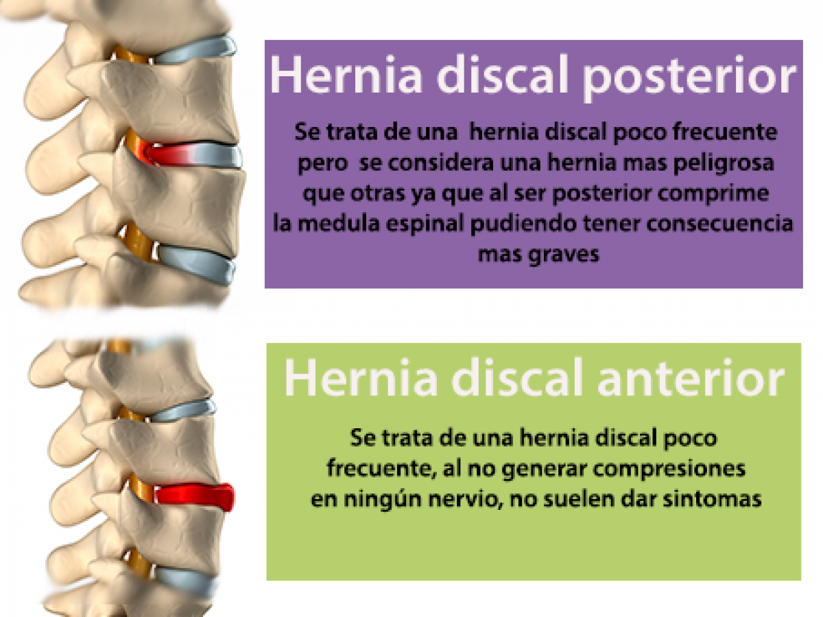 De graves hernia disco sintomas